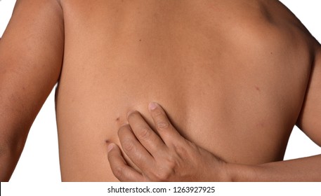 Body Acne Or Back Acne Isolated On White Background. Can Used For Skin Care And Health Care Content. Man Used Hand Scratching Black Spot On Back Skin.