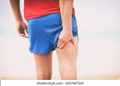 Body Acne Man Scratching Itchy Pimples On Back Leg Thigh -skin Allergy To Poison Ivy Plant Irritation Causing Hives Or Red Rash. Hiking Hiker Wearing Shorts With Skincare Problem.