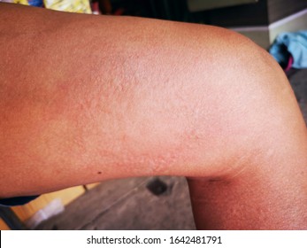 Body Acne Man Scratching Itchy Pimples On Back Leg Thigh -skin Allergy To Poison Ivy Plant Irritation Causing Hives Or Red Rash. Hiking Hiker Wearing Shorts With Skincare Problem.