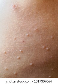 The Body Of The Child Is Strewn With Rash. Disease Mollusk.Pimples On The Body Of The Child.