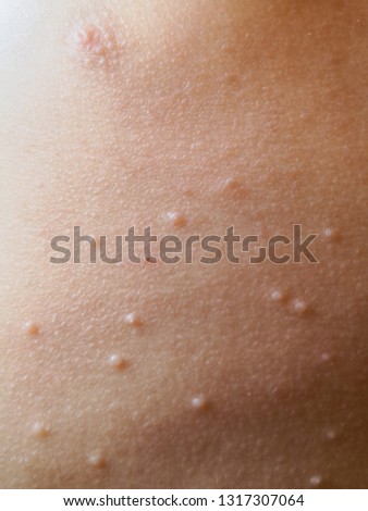 The body of the child is strewn with rash. Disease mollusk.Pimples on the body of the child.