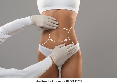 Body Contouring Concept. Unrecognizable Doctor Wearing Gloves Touching Female Body With Marked Lines In Abdomen Zone, Woman Patient Preparing For Liposuction Plastic Surgery, Cropped Shot