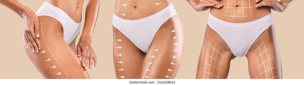 Body Sculpting Concept. Slim Female With Lifting Up Lines On Different Sides Of Figure, Unrecognizable Woman In White Underwear Demonstrating Perfect Shape After Cosmetic Surgery, Collage