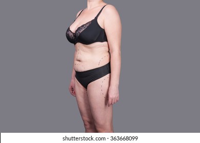 BODY Women After Childbirth, Markings On The Body Liposuction, Excess Fat Woman On Gray Background.Female Body With Underwear, Without Photoshop, Obesity, Stretch Marks, Wrinkles On His Stomach.   