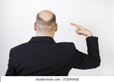 Bold Sad Man Worrying About Hair Loss Problem