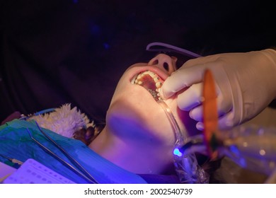 Bonding Of Dental Braces And Expander. Orthodontic Treatment. Dentist Put On Metal Brackets Using Adhesive Dental Glue. Girl With Open Mouth At The Dental Chair.