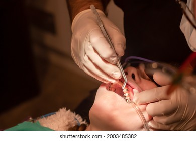 Bonding Of Dental Braces And Expander. Orthodontic Treatment. Dentist Put On Metal Brackets Using Adhesive Dental Glue. Girl With Open Mouth At The Dental Chair.