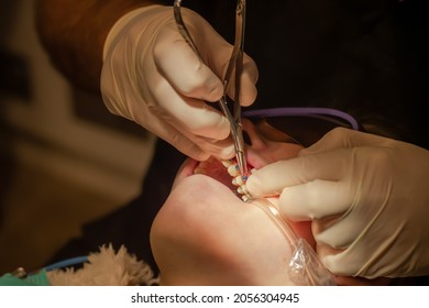 Bonding Of Dental Braces. Orthodontic Treatment. Dentist Put Rubber On Metal Brackets On Teeth With Adhesive Glue. Girl With Open Mouth At The Dental Chair.