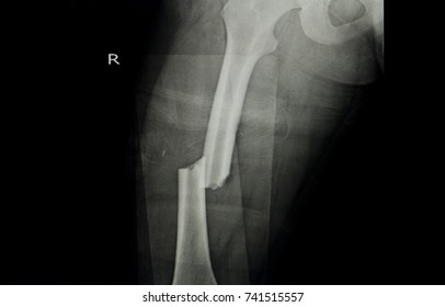 Bone Broken,Femur Fracture, Image  X-ray