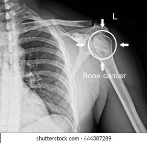 Bone Cancer In  Shoulder