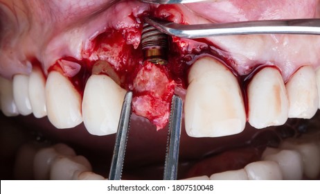 Bone Fragment To Be Added To The Area Of The Central Tooth After Implantation