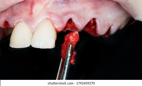 Bone Fragment Before Adding During Implantation And Complex Dental Surgery