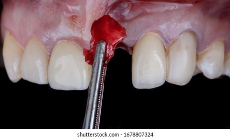 Bone Fragment For Extension Before Dental Implantation