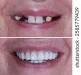 Bone integrated dental implant treatment with jaw surgery in dental dentistry. All on Four and All on X treatment for fully edentulous jaws. Dental implant before and after. Full arch implant-supporte