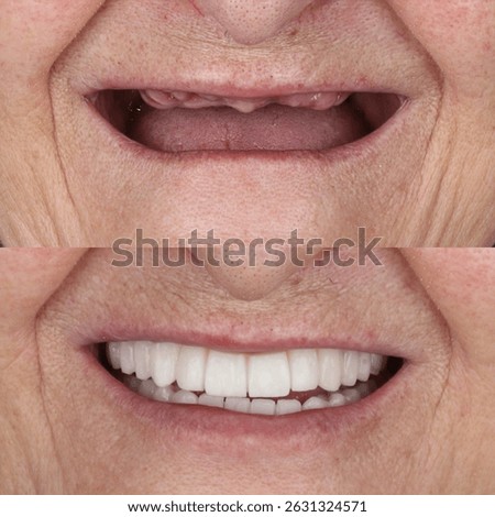 Bone level dental implants and full arch dental prosthesis in dentistry. Full mouth implant supported prosthesis for edentulous jaws. Dental before after and smile makeover.

