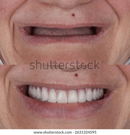 Bone level dental implants and full arch dental prosthesis in dentistry. Full mouth implant supported prosthesis for edentulous jaws. Dental before after and smile makeover.

