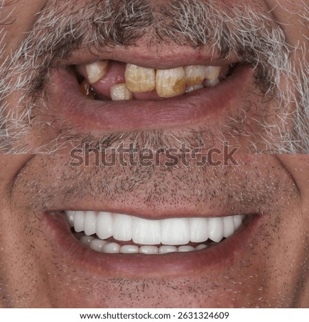 Bone level dental implants and full arch dental prosthesis in dentistry. Full mouth implant supported prosthesis for edentulous jaws. Dental before after and smile makeover.

