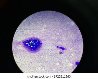 Bone Marrow Aspirate View Under Microscope