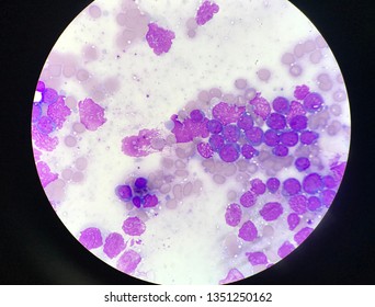 Bone Marrow Aspiration And Smear : Burkitt's Lymphoma