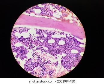 Bone Marrow Biopsy H And E Stain Showing Eosinophilia