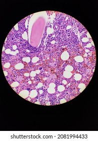 Bone Marrow Biopsy H And E Stain Showing Eosinophilia