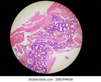 Bone Marrow Biopsy H And E Stain Showing Eosinophilia