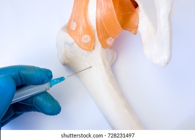Bone marrow examination procedure: biopsy, aspiration or paracentesis concept photo. Doctor holds in hand dressed in glove syringe needle and puncture model of hip bone to take analysis of bone marrow