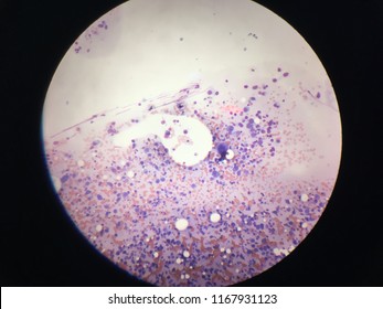 Bone Marrow Of Multiple Myeloma