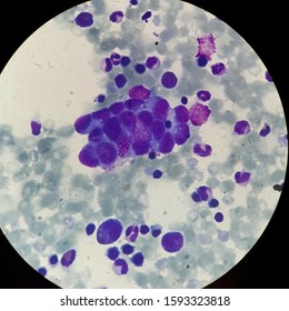 Bone Marrow With Neuroblastoma Tumor Cells