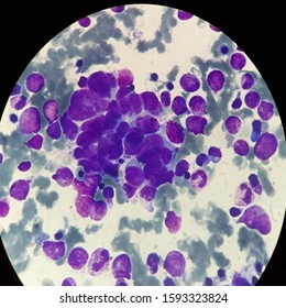 Bone Marrow With Neuroblastoma Tumor Cells