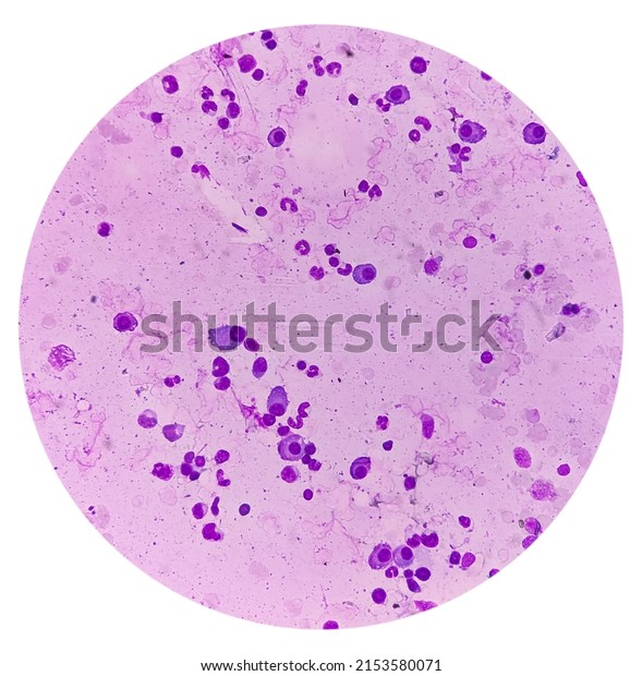 Bone marrow study: a\
megakaryocyte is a large bone marrow cell with a lobated nucleus\
responsible for the production of blood thrombocytes\
(platelets).