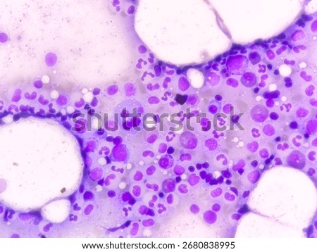 Bone marrow study: Plasma cell dyscrasia. Smoldering or early multiple myeloma (the patient has a history of plasmacytoma at the dorsal vertebral level -L2)