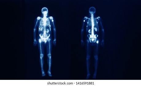 Bone Scan Image Of A Patient Showing Multiple Bone And Spine Metastasis. The Image Show The Outline Of Skeleton On Front And Back. Nuclear Medicine. Dark Background.