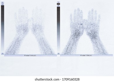 Bone Scintigraphy Or Scintigram Of The Hands Of A 50 Year Old Woman, Showing Degenerative Joint Disease