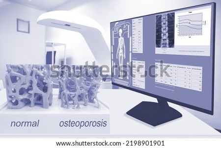 Bone spongy structure close-ups, normal and with osteoporosis and showing on monitor and blurry room density background