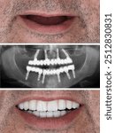 Bone-integrated dental implant treatment with jaw surgery in dental dentistry. Full-arch dental prosthesis for an edentulous jaw. Dental before and after, smile makeover.







