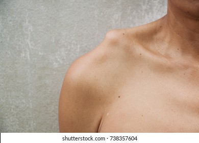 Bony Shoulders