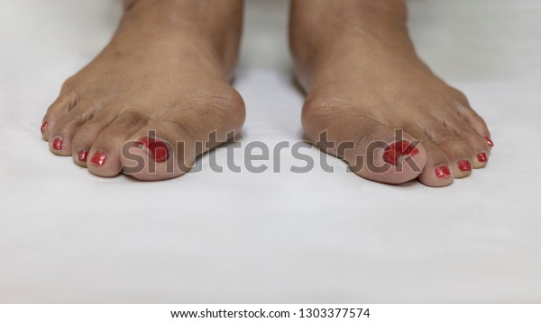 big toe pronation