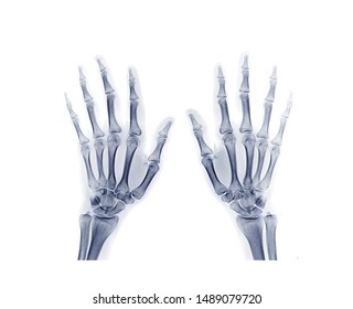  both hand AP view isolated on white background . x-ray image of hand. - Shutterstock ID 1489079720