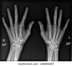 Both Hands X-Ray posteroanterior view  - Shutterstock ID 2186850407