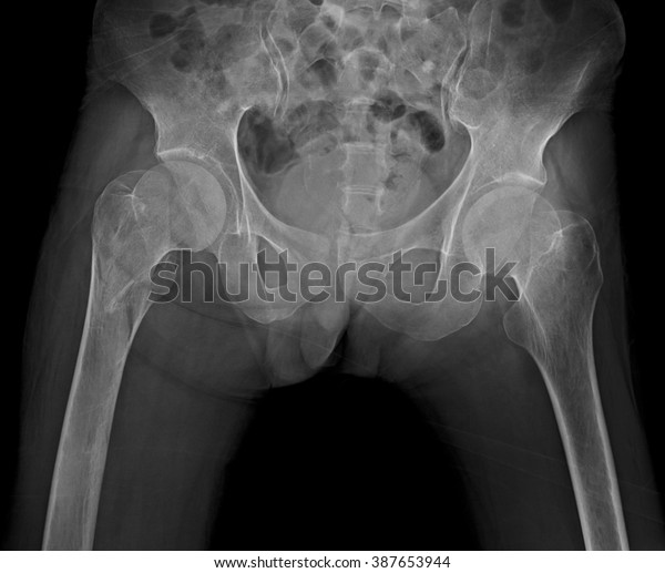 normal hip xray femoral neck fracture xray