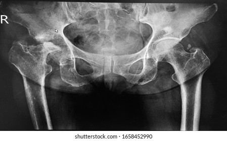 normal xray of hip joint