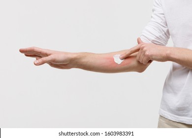 Bouts Of Allergies Concept. Allergic Reaction, Itch, Dermatitis, Dry Skin. Man Is Applying Cream/ointment On The Swell Skin Against Mosquito Bites, Isolated On White Background, Close Up. 