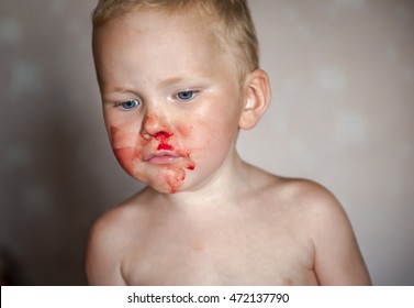 Boy With A Bloody Nose