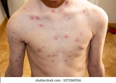 Boy With Chicken Pox