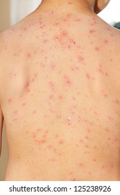 Boy With Chicken Pox Rash