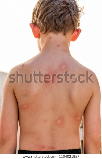 Boy Child Many Infected Mosquito Bites Stock Photo Edit Now