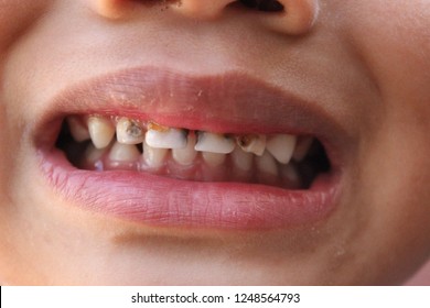 The Boy Had Tooth Decay Because He Did Not Clean His Teeth