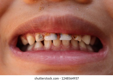 The Boy Had Tooth Decay Because He Did Not Clean His Teeth