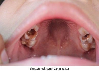 The Boy Had Tooth Decay Because He Did Not Clean His Teeth